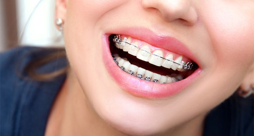 affordable braces near me