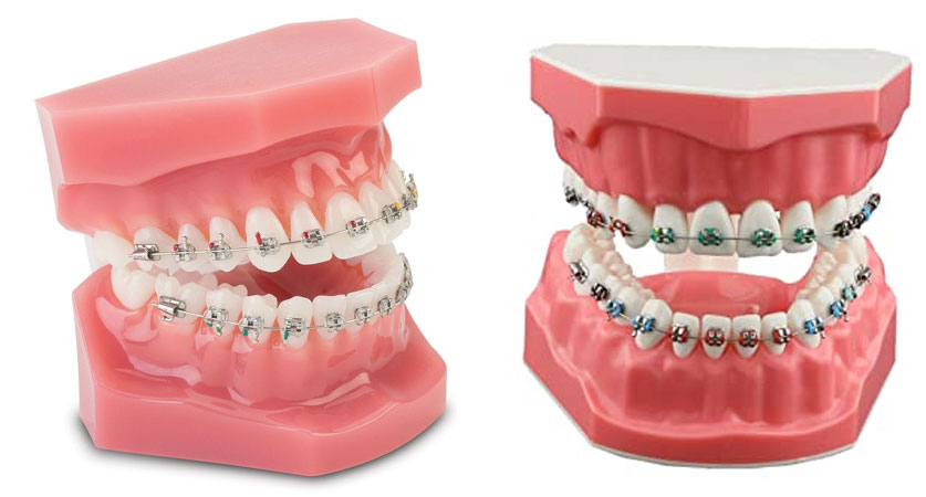 orthodontist braces cost