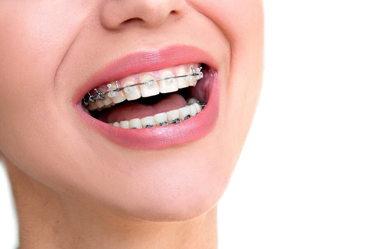 ceramic braces