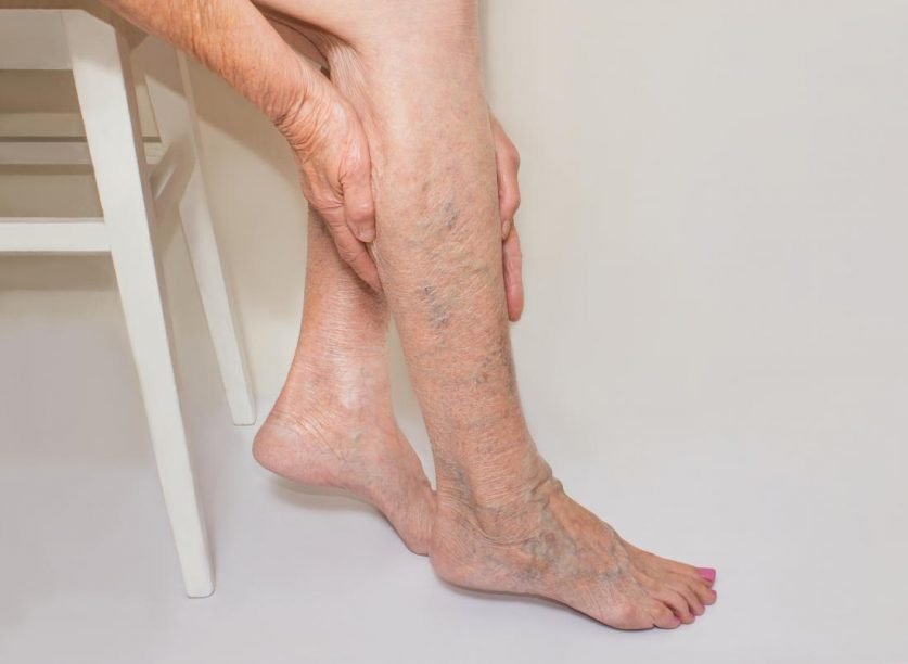 Spider Vein Treatment