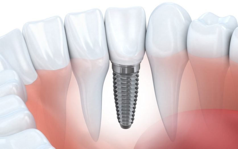 Dental implant