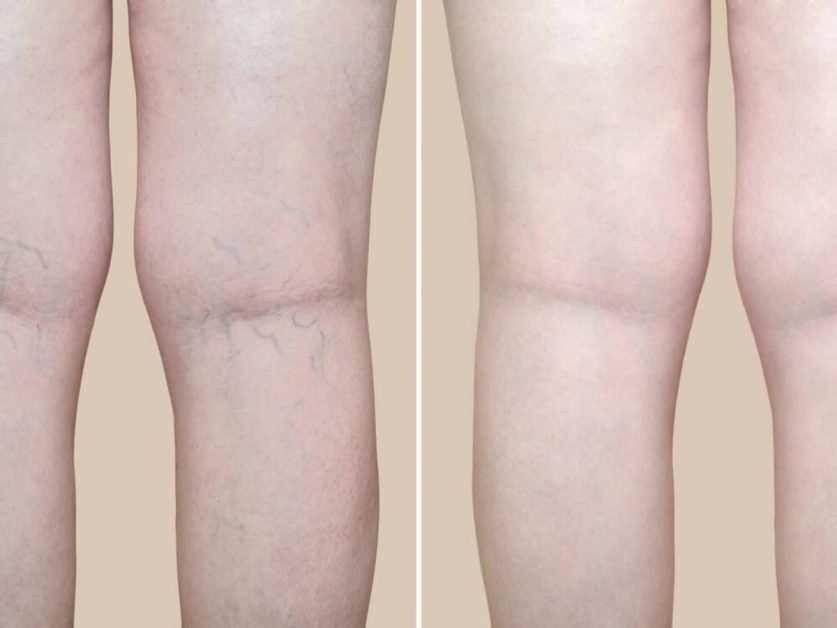 Varicose Vein Laser Treatment