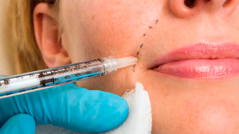 dermal fillers