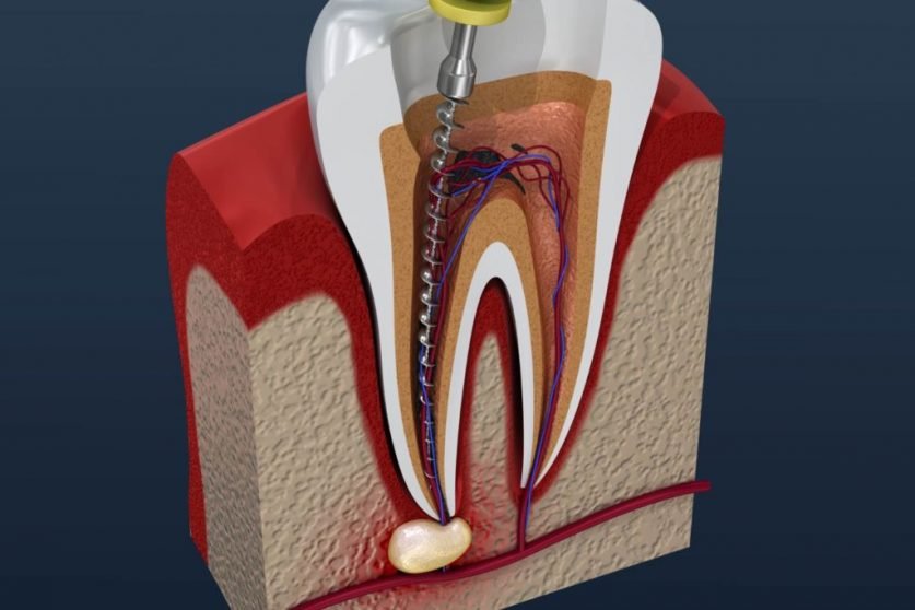 root canal