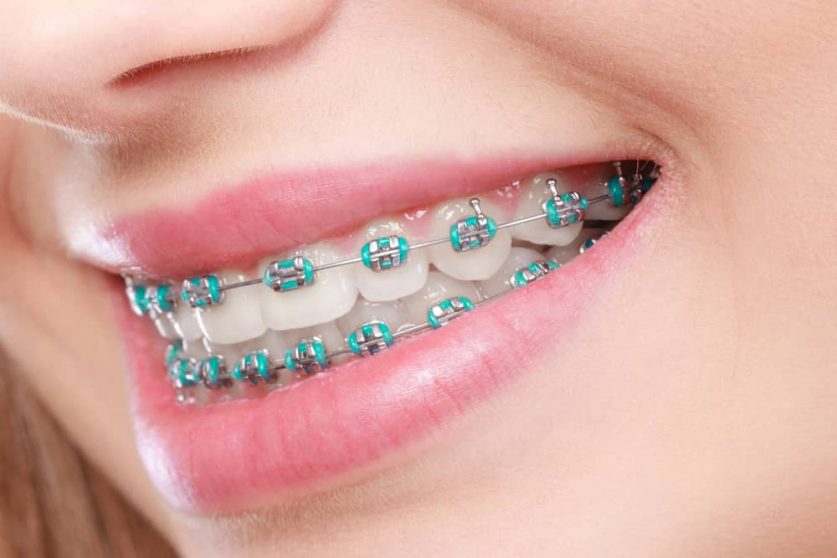 FOODS TO AVOID WITH BRACES