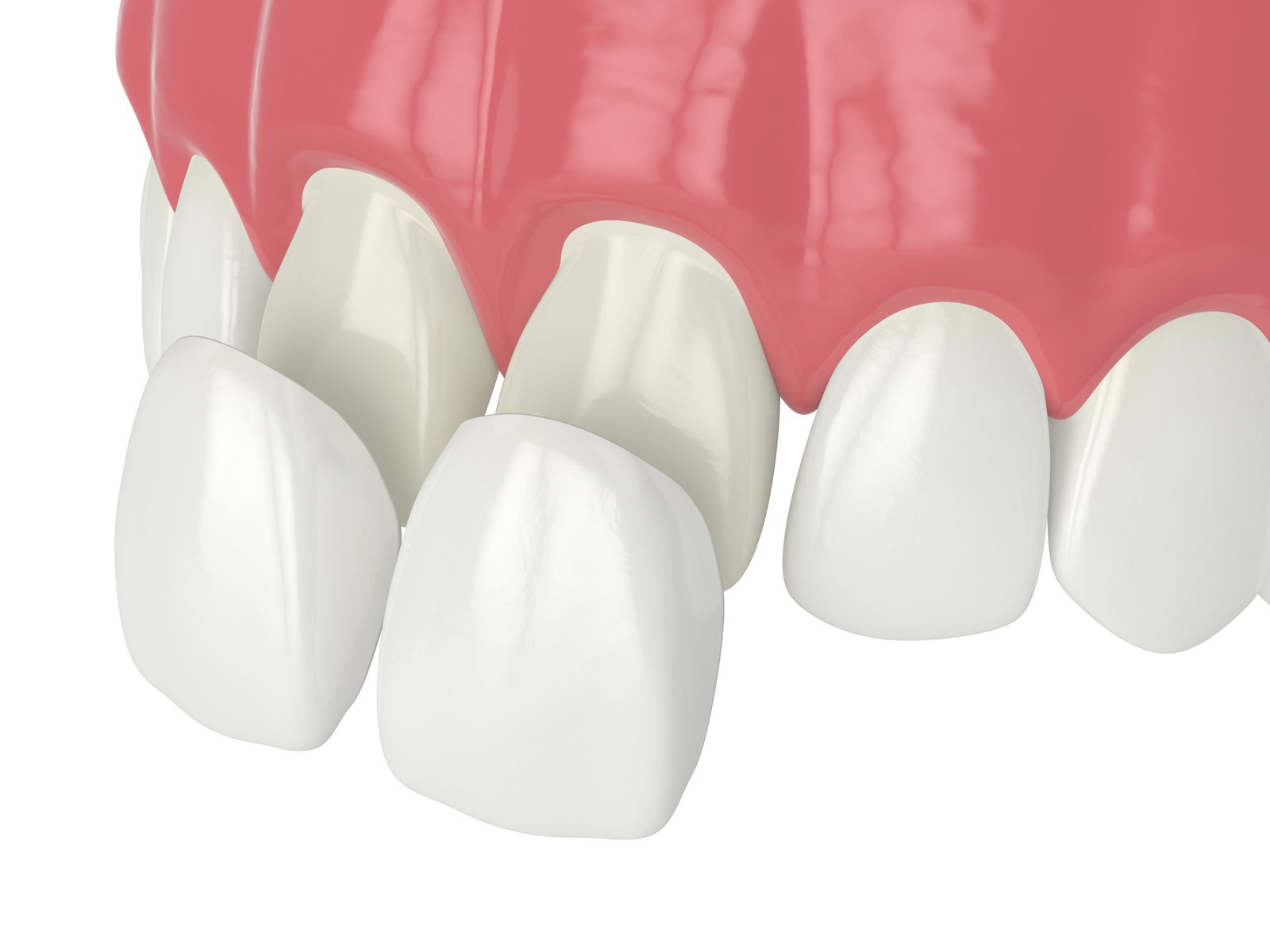 dental veneers