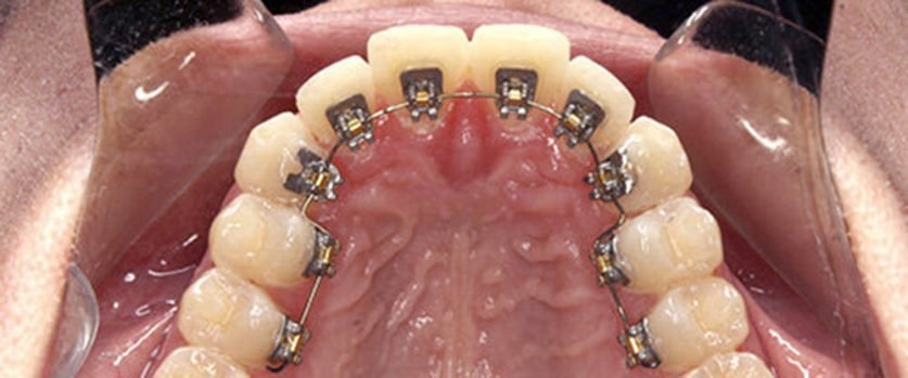 Lingual Braces