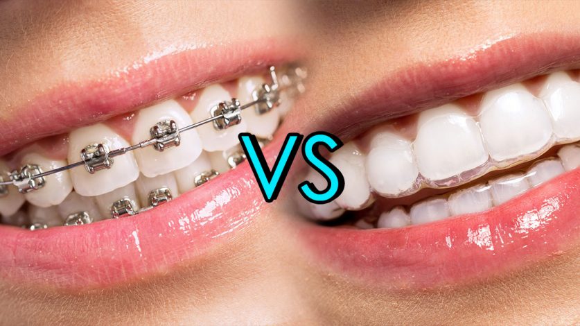 Differences Between Traditional Braces And Invisalign