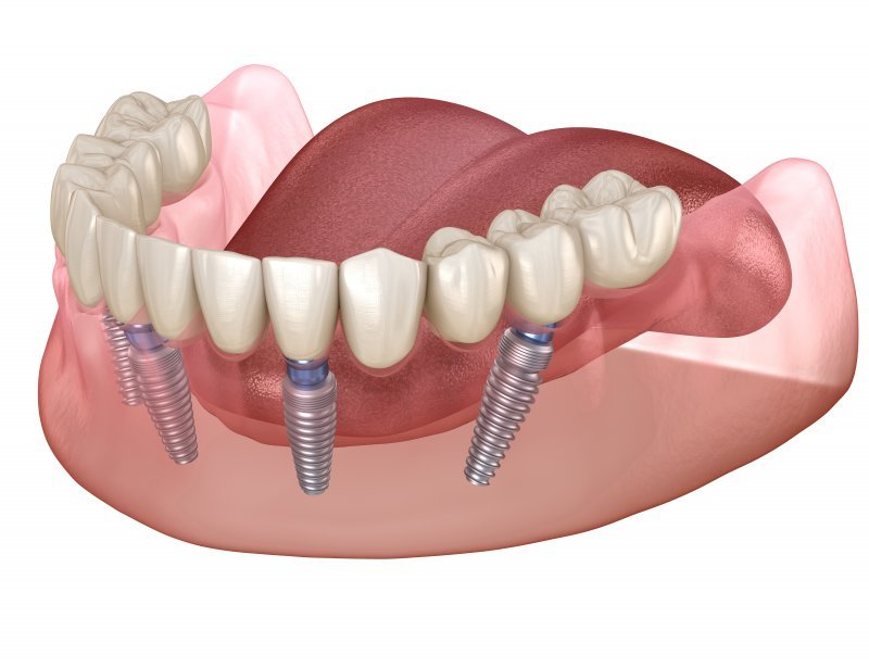 Dental Implants