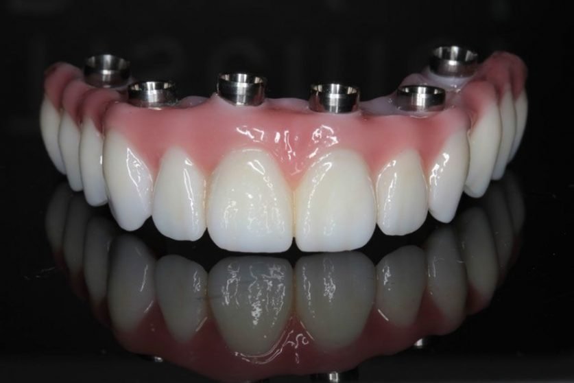 Full Mouth Dental Implants