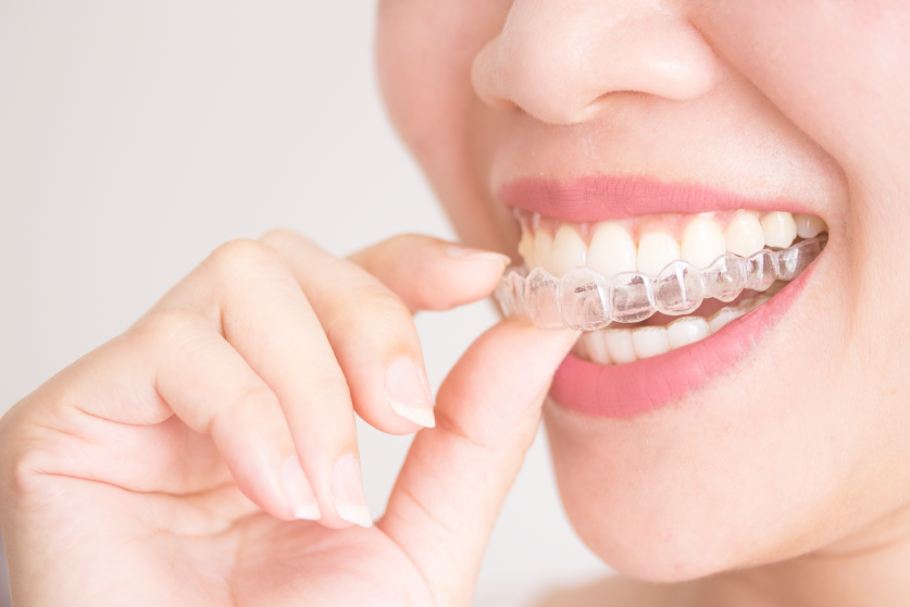 Invisalign Aligners