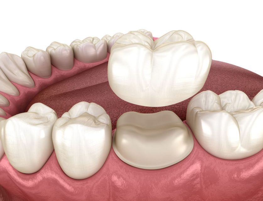 Dental Crown Restoration