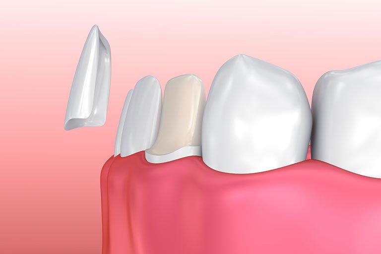 Dental Veneers