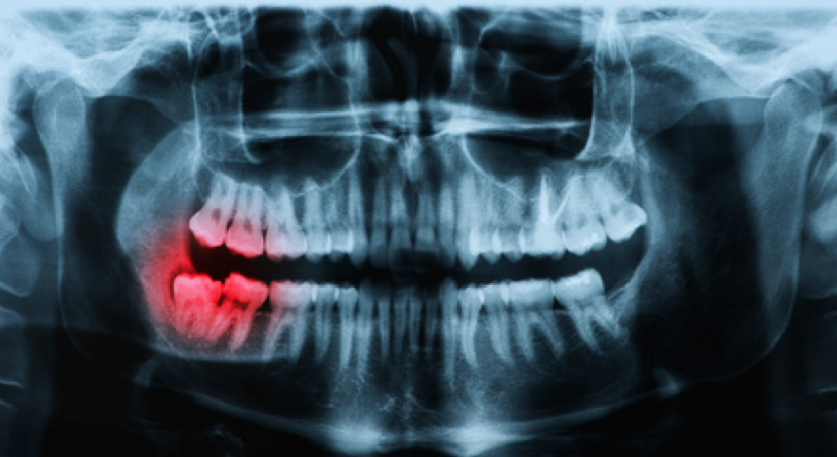 Dental X-Ray