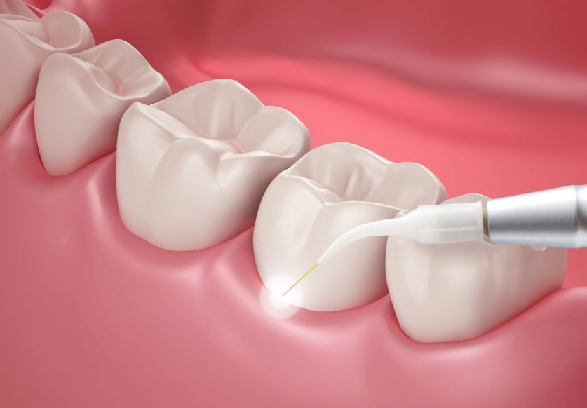 Laser Dentistry For Gum Disease