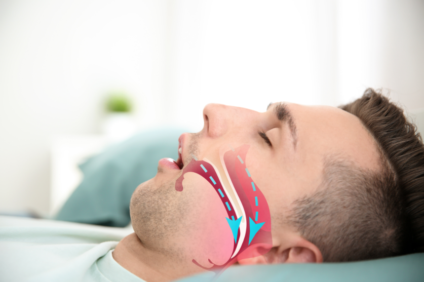 Obstructive Sleep Apnea