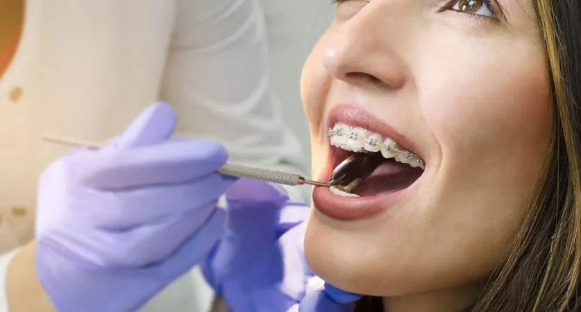 dental braces