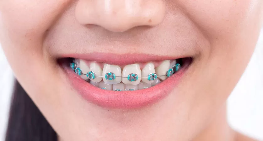 dark blue braces
