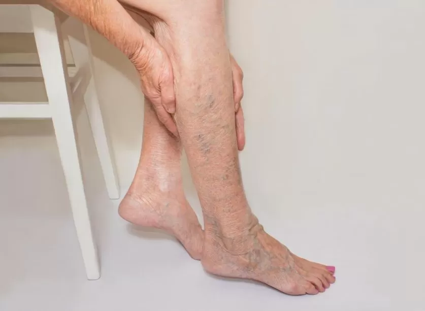 Spider Vein Treatment