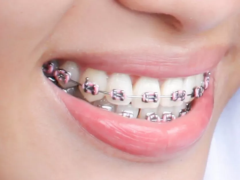 Braces Colors