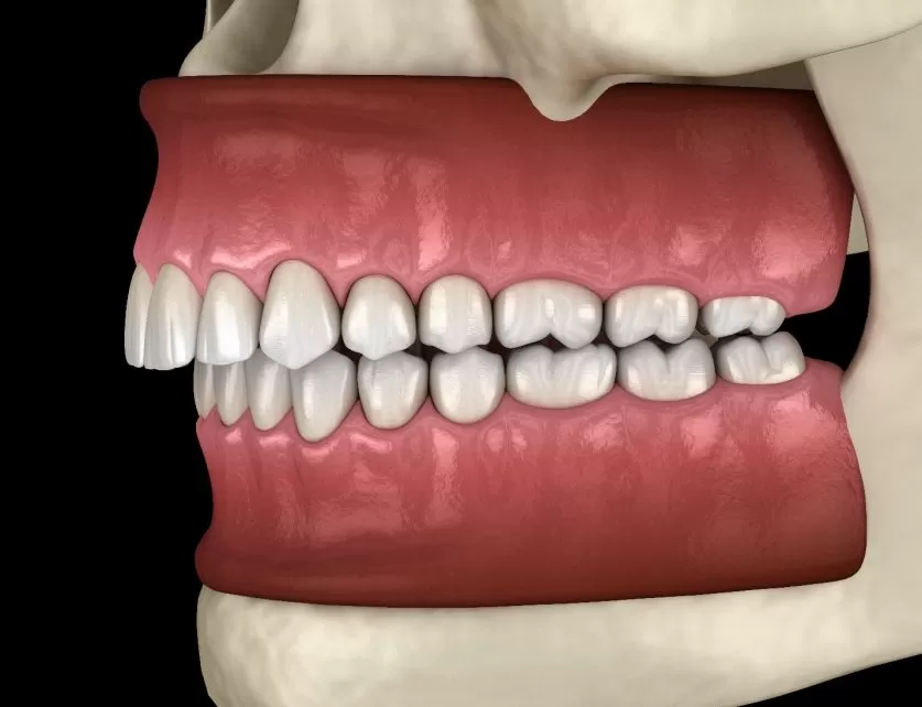 overbite braces