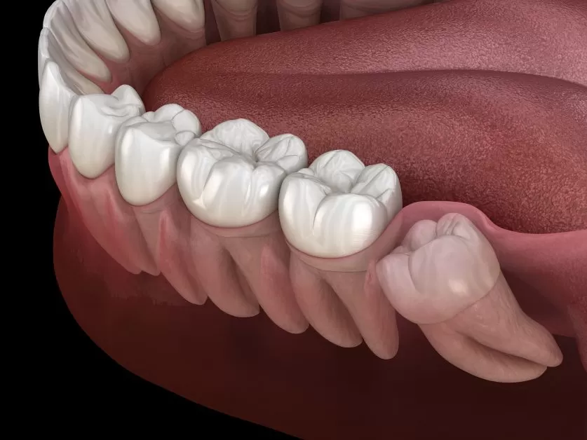 wisdom teeth removal