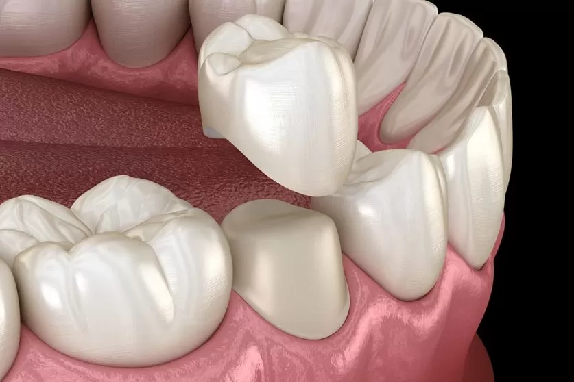 Dental Crown Procedure