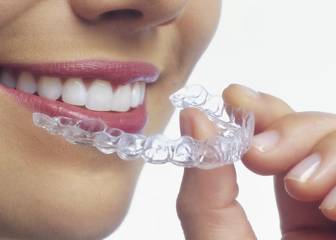 Invisalign aligners
