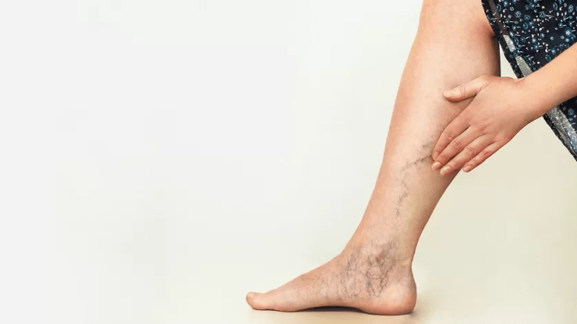 Spider Veins