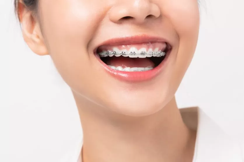 braces